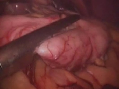 Lap. Sleeve Gastrectomy