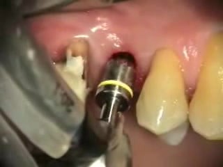 How To Profile Alveolar Process Bone?