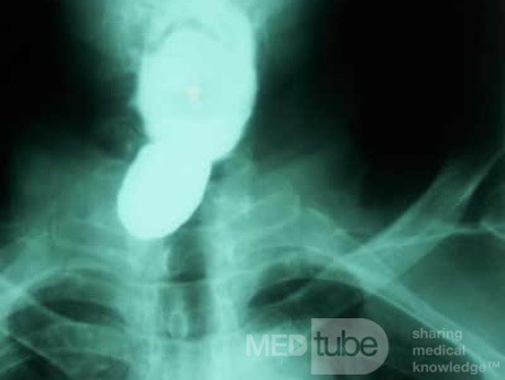 Zenker´s Diverticula