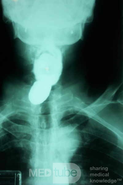 Zenker´s Diverticula