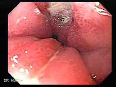 Hourglass Stomach - Closer Look at the Generative Epithelium, Part 1