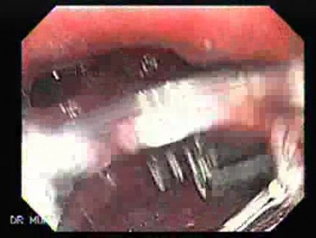 Early Gastric Cancer - Endoscopy (4 of 21)