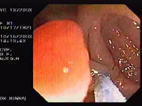 Tubulo - Villous Adenoma - Endoscopy (5 of 28)