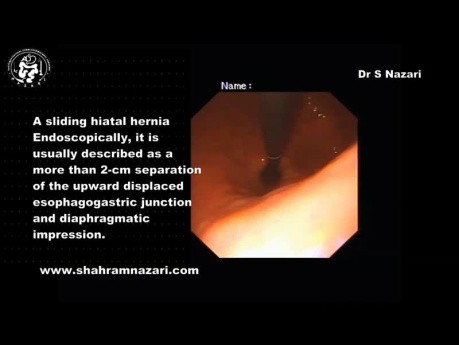 A Large Sliding Hiatal Hernia