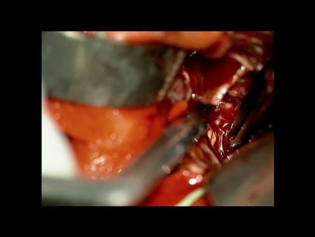 Arterio-Venous Malformation AVM