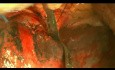 Open Right Lower Bilobectomy for Non-Small Lung Cancer