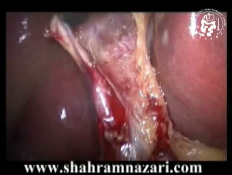 Laparoscopic Cholecystectomy with Intraoperative Cholangiography