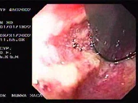 Hemorrhagic Esophagitis Due To Alcoholism - Cardia