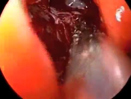 Inflamation of Maxillary Sinus Caused by Fungus