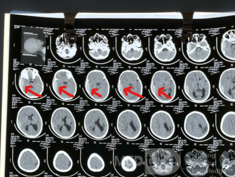 Epidural Hematoma