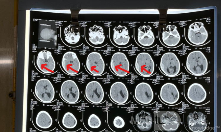 Epidural Hematoma