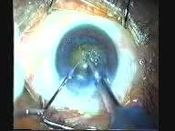 Phacoemulsification - Chop And Slice Technique