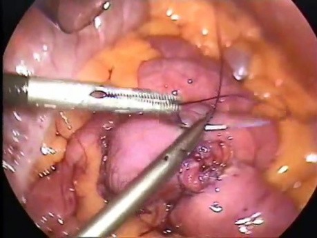 Small bowel anastomosis - laparoscopic surgery