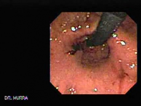 The Stomach - Video Endoscopic Sequence (3 of 6)