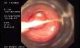 Banding of Esophageal Varices - Assessment of Esophagus, View Through Banding Device