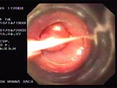 Banding of Esophageal Varices - Assessment of Esophagus, View Through Banding Device