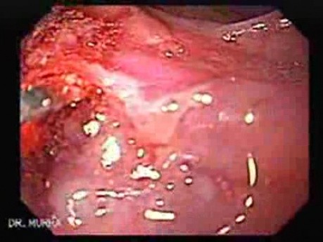 Duodenal Ulcer and Bleeding (22 of 23)