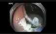 Ascending Colon - Flat Lesion Tethered by Jumbo Biopsy - EMR