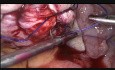 Lap Myemectomy in Big Post Wall Fibroid