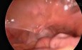 Laparoscopic Sigmoidectomy, Sub IMV Approach