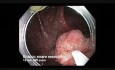 Colonoscopy Channel - En-bloc Snare Resection of Sessile Serrated Adenoma
