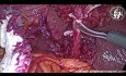 Step by Step Laparoscopic Cholecystectomy