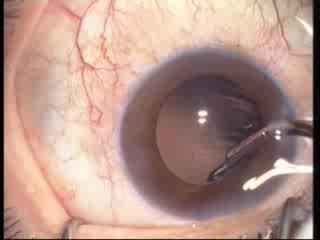 Phacoemulsification - IOL