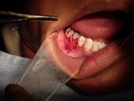 Part 6/8: Root Coverage Surgery - Mandibular Premolar - Suture Finalization