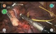 Robotic Right Lower Lobectomy CMR Versius