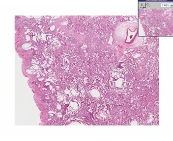 Diffuse Interstitial Fibrosis