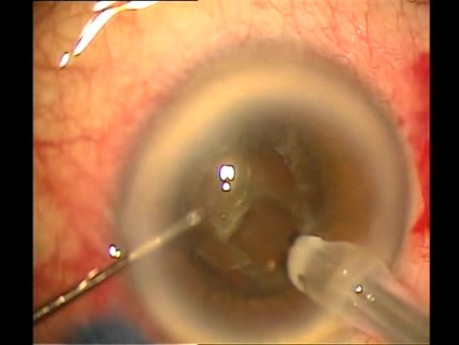 Results of phacoemulsification after microtrack filtration operation-a one minute glaucoma procedure