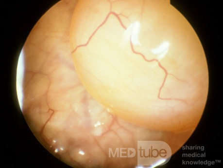 Maxillary Sinus Cyst [sinuscopic examination]