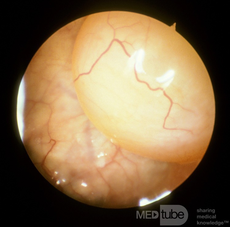 Maxillary Sinus Cyst [sinuscopic examination]