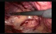 TEP for Bilateral Large Direct Inguinal Hernia