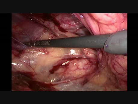 TEP for Bilateral Large Direct Inguinal Hernia