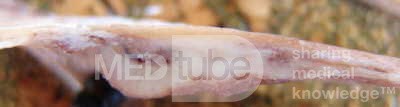 Early Gastric Cancer (21 of 21)