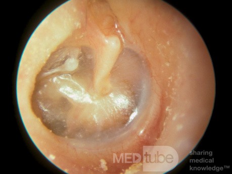 Myringostapediopexy Right Ear