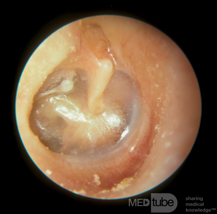 Myringostapediopexy Right Ear