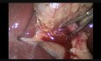 Mini-Laparoscopic Cholecystectomy