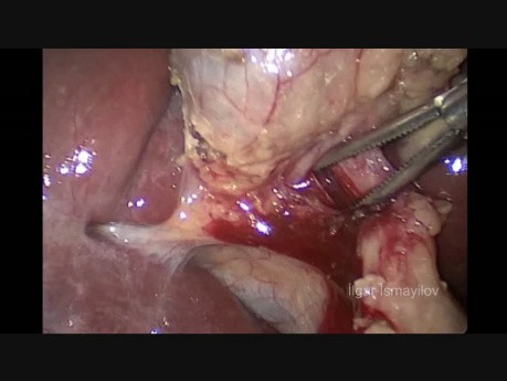 Mini-Laparoscopic Cholecystectomy