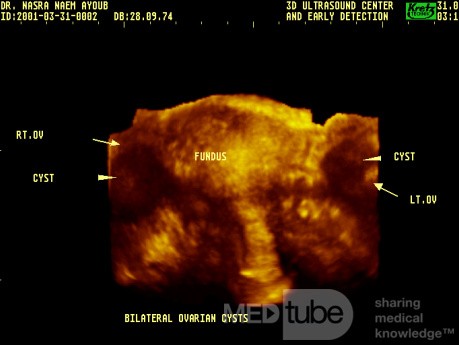 WHOLE UTERINE APPEARANCE BY THREE DIMENSION ULTRASOUND