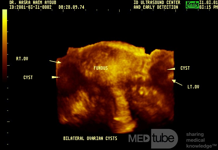 WHOLE UTERINE APPEARANCE BY THREE DIMENSION ULTRASOUND