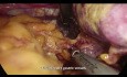 Total laparoscopic D2 gastrectomy