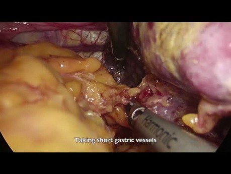 Total laparoscopic D2 gastrectomy