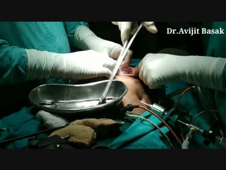 Removal of Ovarian Cyst by Umbilical Port