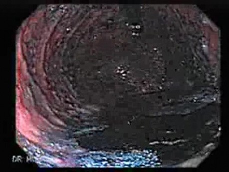 Familial Adenomatous Polyposis of the Colon (29 of 29)