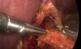 Laparoscopic Heller Myotomy for Achalasia with Large Hiatal Hernia