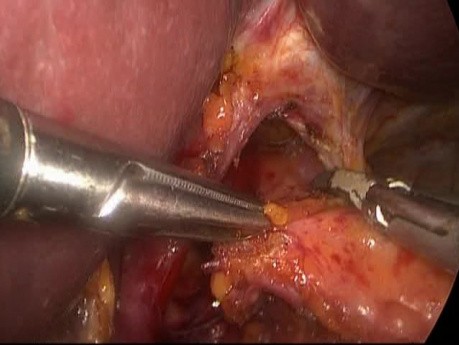 Laparoscopic Heller Myotomy for Achalasia with Large Hiatal Hernia