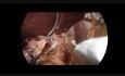 Laparoscopic Gastric Sleeve one year post Gastric Plication