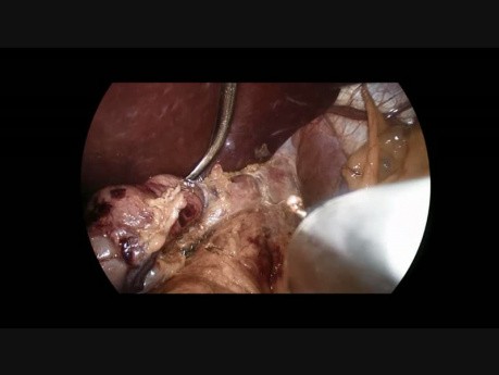 Laparoscopic Gastric Sleeve one year post Gastric Plication